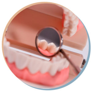 Benefits of All on 4 Dental Implants